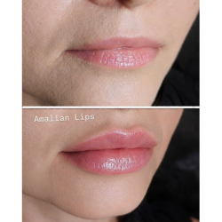 augmentare buze aid hialuronic 3